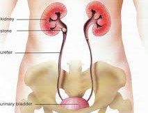kidney stone care