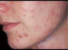 major skin disease