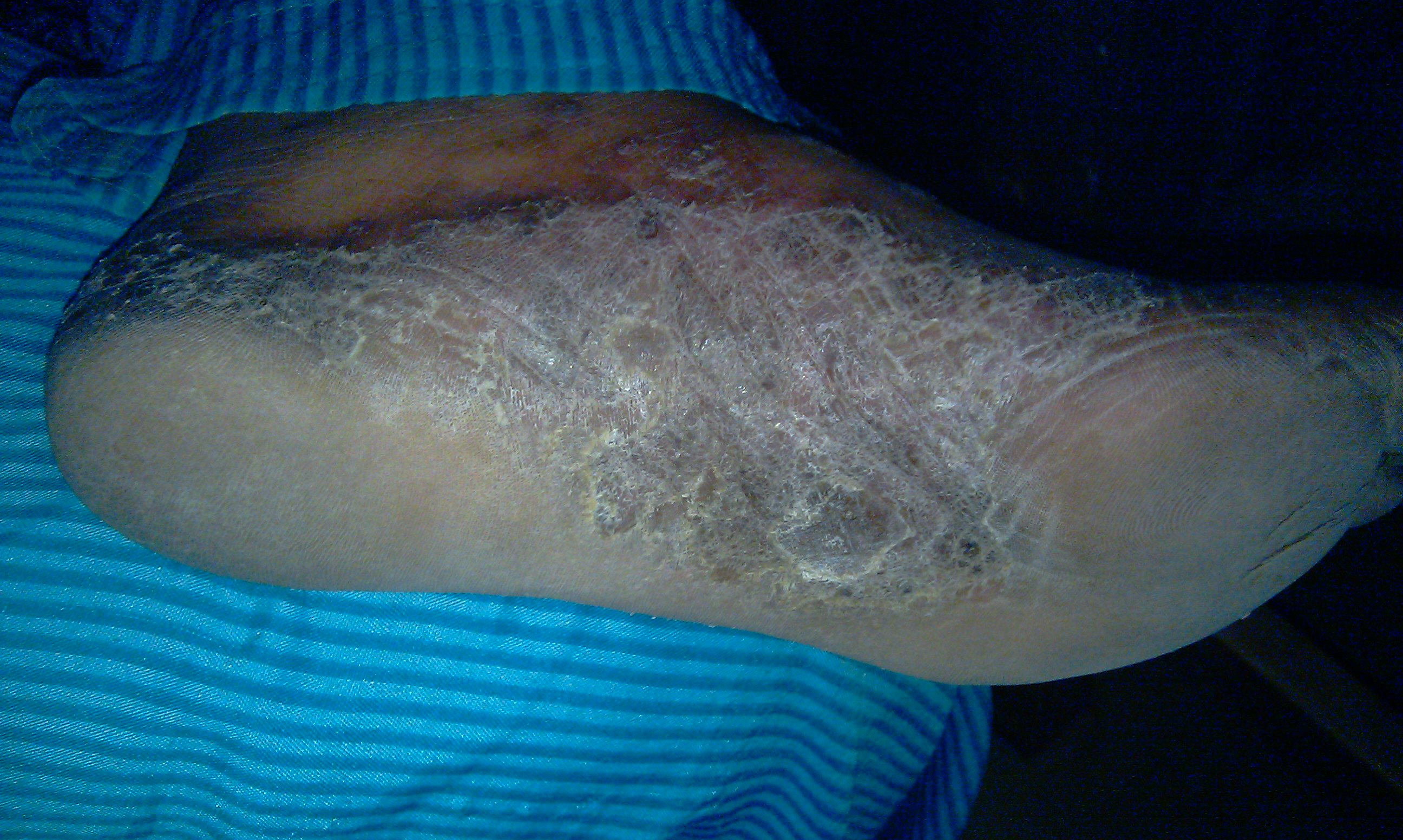 elephant skin disease #9