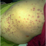 Paama/ Scabies